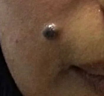 Skin Tag Removal Close-up